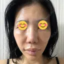 糸リフト アリエル美容クリニック 大宮院 DAY 2 サムネイル用