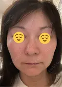 エレクトロポレーション 湘南美容クリニック 松戸院 AFTER サムネイル用