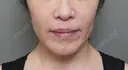 糸リフト / バッカルファット除去 / 脂肪吸引（顔） / ジョールファット除去 / ボトックス（エラ・小顔） アリエル美容クリニック 大宮院 AFTER サムネイル用
