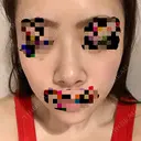 小鼻縮小（切開） / スレッドノーズ / 鼻尖縮小 / ヒアルロン酸注入（鼻） キップン整形外科 AFTER サムネイル用