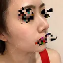 小鼻縮小（切開） / スレッドノーズ / 鼻尖縮小 / ヒアルロン酸注入（鼻） キップン整形外科 DAY 17 サムネイル用