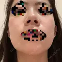 小鼻縮小（切開） / スレッドノーズ / 鼻尖縮小 / ヒアルロン酸注入（鼻） キップン整形外科 DAY 17 サムネイル用