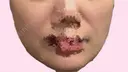 糸リフト / メーラーファット除去 4Dクリニック AFTER サムネイル用
