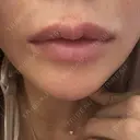 ヒアルロン酸注入（唇） HAAB BEAUTY CLINIC 名古屋院 AFTER サムネイル用