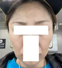 ジャルプロ 美容皮膚科エルムクリニック 大阪院 AFTER サムネイル用