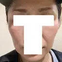 ジャルプロ 美容皮膚科エルムクリニック 大阪院 DAY 3 サムネイル用