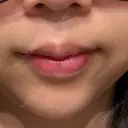 ボトックス（口角） veary clinic DAY 35 サムネイル用
