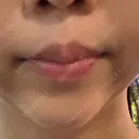 ボトックス（口角） veary clinic DAY 36 サムネイル用