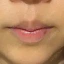 ボトックス（口角） veary clinic DAY 20 サムネイル用