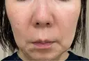 ピコレーザートーニング（美白・肝斑） / ピコスポット APスキンクリニック銀座 DAY 9 サムネイル用