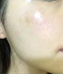 水光注射（ハリ・美肌） プチパーティー医院 DAY 6 サムネイル用