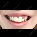 その他（審美歯科/矯正歯科） / セラミック 東京美容外科 赤坂院 DAY 0 サムネイル用