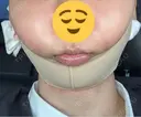 脂肪吸引（顔） / ジョールファット除去 / ボトックス（あご） / ヒアルロン酸注入（あご） / ボトックス（首） WOM CLINIC GINZA （ワム クリニック ギンザ） DAY 0 サムネイル用