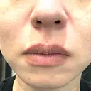 肌育注射（ジュベルックなど） / ニードルRF（ポテンツァなど） PureMe Skin Clinic（ピュアミースキンクリニック麻布） AFTER サムネイル用