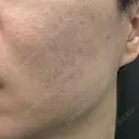肌育注射（ジュベルックなど） / ニードルRF（ポテンツァなど） PureMe Skin Clinic（ピュアミースキンクリニック麻布） DAY 37 サムネイル用