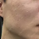 肌育注射（ジュベルックなど） / ニードルRF（ポテンツァなど） PureMe Skin Clinic（ピュアミースキンクリニック麻布） DAY 37 サムネイル用