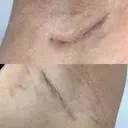 豊胸（シリコンバッグ） ナグモクリニック 東京院 DAY 22 サムネイル用