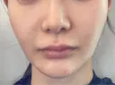 RF（高周波）たるみ治療 WITH BEAUTY CLINIC DAY 0 サムネイル用