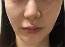 RF（高周波）たるみ治療 WITH BEAUTY CLINIC AFTER サムネイル用