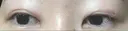 二重切開 表参道スキンクリニック 表参道院 AFTER サムネイル用