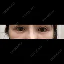 クマ治療 / 目尻切開 / タレ目形成・グラマラスライン（切開） / 脂肪注入（目の下） 藤・ナチュレ美容クリニック 銀座院 DAY 16 サムネイル用