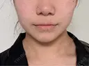 インモード 博多美容外科/美容皮膚科 ビラビューティークリニック AFTER サムネイル用