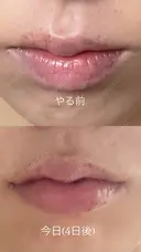 ヒアルロン酸注入（唇） PRO CLINIC プロクリニック 銀座院 AFTER サムネイル用