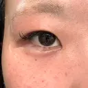 その他（目元） / ヒアルロン酸注入（涙袋） / ボトックス（あご） / ヒアルロン酸注入（唇） / ボトックス（口角） / ボトックス（ガミースマイル） / その他（口元） 銀座美容外科クリニック 銀座院 DAY 0 サムネイル用