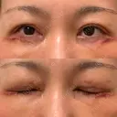 二重切開 / 眼瞼下垂（切開） / 目元修正 湘南美容クリニック 神戸三宮院 DAY 10 サムネイル用