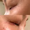 二重切開 / 眼瞼下垂（切開） / 目元修正 湘南美容クリニック 神戸三宮院 DAY 10 サムネイル用