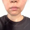 脂肪溶解注射（顔） / ハイフ（顔） HINATA クリニック AFTER サムネイル用
