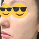 ピーリング（ハリ・ツヤ） HAAB CLINIC 池袋院 AFTER サムネイル用