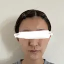 脂肪注入（額） / ボトックス（あご） / ヒアルロン酸注入（唇） / 脂肪注入（輪郭） アリエル美容クリニック 大宮院 DAY 88 サムネイル用
