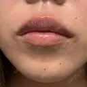 その他（目元） / ヒアルロン酸注入（涙袋） / ボトックス（あご） / ヒアルロン酸注入（唇） / ボトックス（口角） / ボトックス（ガミースマイル） / その他（口元） 銀座美容外科クリニック 銀座院 DAY 4 サムネイル用