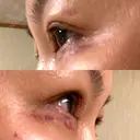 二重切開 / 眼瞼下垂（切開） / 目元修正 湘南美容クリニック 神戸三宮院 DAY 11 サムネイル用