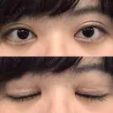 二重切開 / 目頭切開 / ほくろ・いぼ切除（肌） / 上まぶたたるみ取り / 上まぶたの脂肪取り 東京美容外科 銀座院 DAY 69 サムネイル用