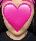 インモード ARTE BEAUTY CLINIC AFTER サムネイル用