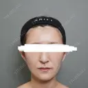脂肪注入（額） / ボトックス（あご） / ヒアルロン酸注入（唇） / 脂肪注入（輪郭） アリエル美容クリニック 大宮院 DAY 95 サムネイル用
