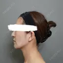 脂肪注入（額） / ボトックス（あご） / ヒアルロン酸注入（唇） / 脂肪注入（輪郭） アリエル美容クリニック 大宮院 DAY 95 サムネイル用