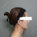 脂肪注入（額） / ボトックス（あご） / ヒアルロン酸注入（唇） / 脂肪注入（輪郭） アリエル美容クリニック 大宮院 DAY 95 サムネイル用
