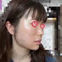 糸リフト / ボトックス（あご） / ヒアルロン酸注入（あご） / ボトックス（エラ・小顔） / ヒアルロン酸注入（唇） / ボトックス（口角） / ヒアルロン酸注入（額） / ヒアルロン酸注入（頬） / ヒアルロン酸注入（目の下） / ボトックス（眉間） / ボトックス（額） / ボトックス（人中） / ヒアルロン酸注入（鼻翼基部） EMMO FACE CLINIC 大宮院 DAY 2 サムネイル用