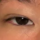 二重埋没 アリエル美容クリニック 大宮院 DAY 15 サムネイル用