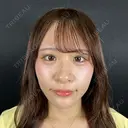 二重埋没 / ほくろ・いぼ切除（肌） / 上まぶたの脂肪取り / タレ目形成・グラマラスライン（切開） / 目元修正 / ボトックス（眉間） 藤・ナチュレ美容クリニック 銀座院 AFTER サムネイル用
