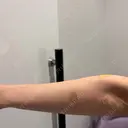 ほくろ・いぼ切除（肌） R Beauty CLINIC 名古屋院 AFTER サムネイル用