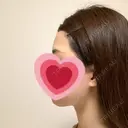 脂肪吸引（顔） R Beauty CLINIC 銀座院 AFTER サムネイル用