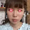 糸リフト / ボトックス（あご） / ヒアルロン酸注入（あご） / ボトックス（エラ・小顔） / ヒアルロン酸注入（唇） / ボトックス（口角） / ヒアルロン酸注入（額） / ヒアルロン酸注入（頬） / ヒアルロン酸注入（目の下） / ボトックス（眉間） / ボトックス（額） / ボトックス（人中） / ヒアルロン酸注入（鼻翼基部） EMMO FACE CLINIC 大宮院 DAY 3 サムネイル用