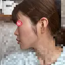 糸リフト / ボトックス（あご） / ヒアルロン酸注入（あご） / ボトックス（エラ・小顔） / ヒアルロン酸注入（唇） / ボトックス（口角） / ヒアルロン酸注入（額） / ヒアルロン酸注入（頬） / ヒアルロン酸注入（目の下） / ボトックス（眉間） / ボトックス（額） / ボトックス（人中） / ヒアルロン酸注入（鼻翼基部） EMMO FACE CLINIC 大宮院 DAY 3 サムネイル用