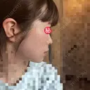 糸リフト / ボトックス（あご） / ヒアルロン酸注入（あご） / ボトックス（エラ・小顔） / ヒアルロン酸注入（唇） / ボトックス（口角） / ヒアルロン酸注入（額） / ヒアルロン酸注入（頬） / ヒアルロン酸注入（目の下） / ボトックス（眉間） / ボトックス（額） / ボトックス（人中） / ヒアルロン酸注入（鼻翼基部） EMMO FACE CLINIC 大宮院 DAY 3 サムネイル用