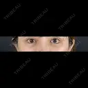 クマ治療 / 目尻切開 / タレ目形成・グラマラスライン（切開） / 脂肪注入（目の下） 藤・ナチュレ美容クリニック 銀座院 DAY 29 サムネイル用