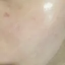 肌育注射（ジュベルックなど） / イオン導入 / 光治療（フォトフェイシャルなど） / ルメッカ Belle Via Clinic DAY 8 サムネイル用